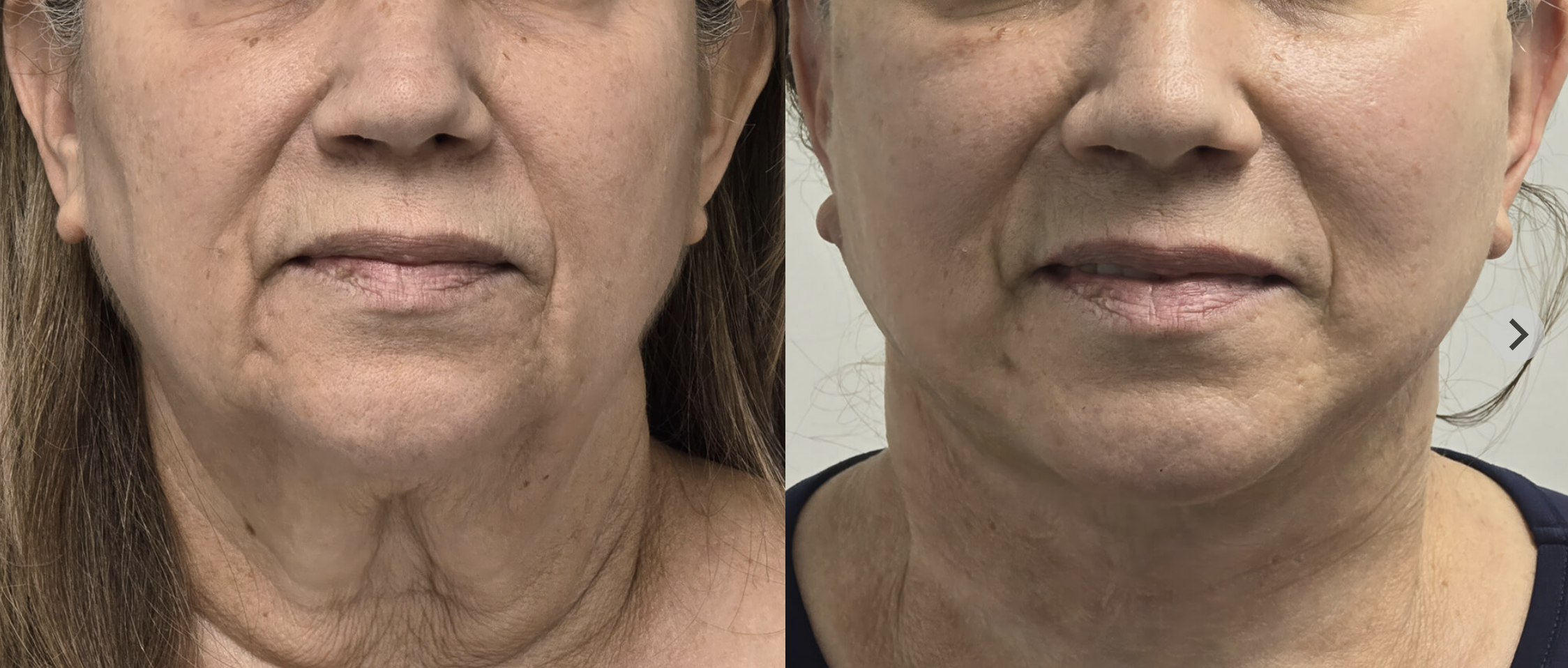Deep plane facelift before and after, front view