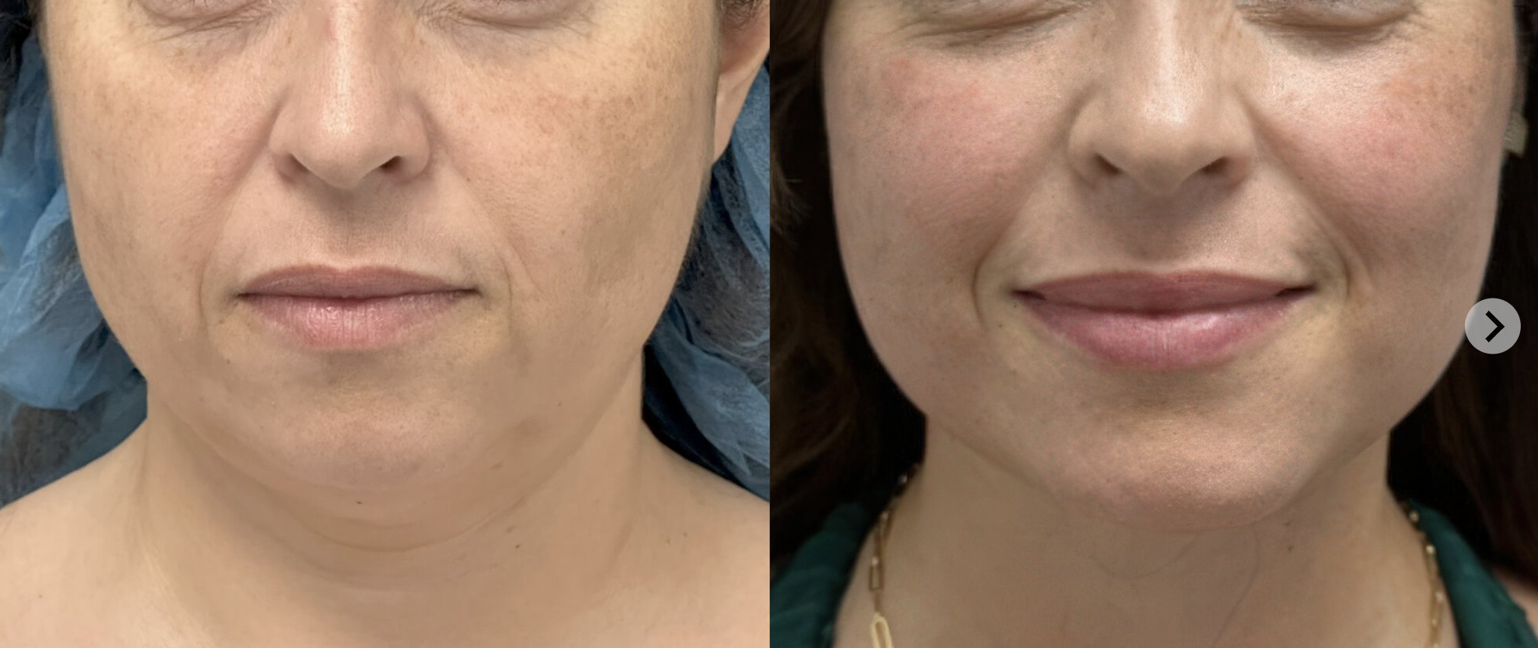 Deep plane facelift before and after, front view