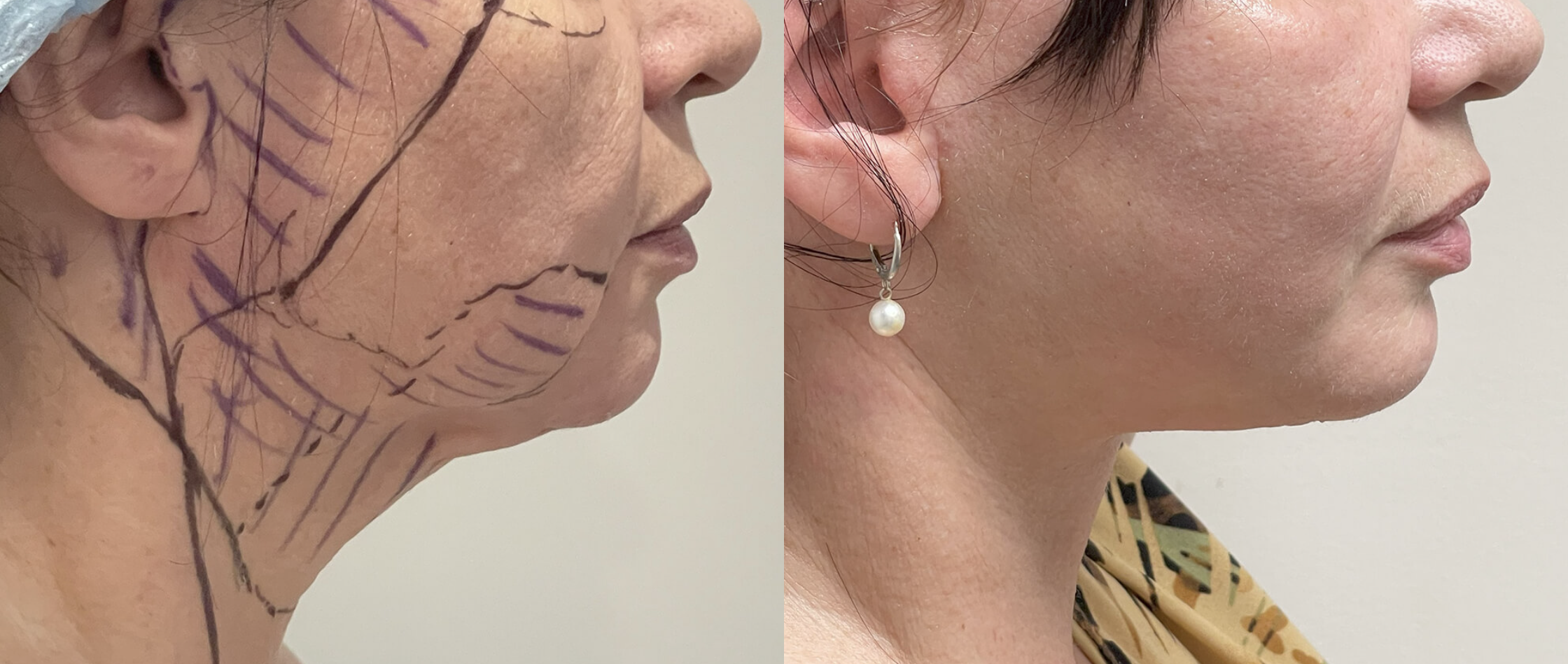 Deep plane facelift before and after, profile view