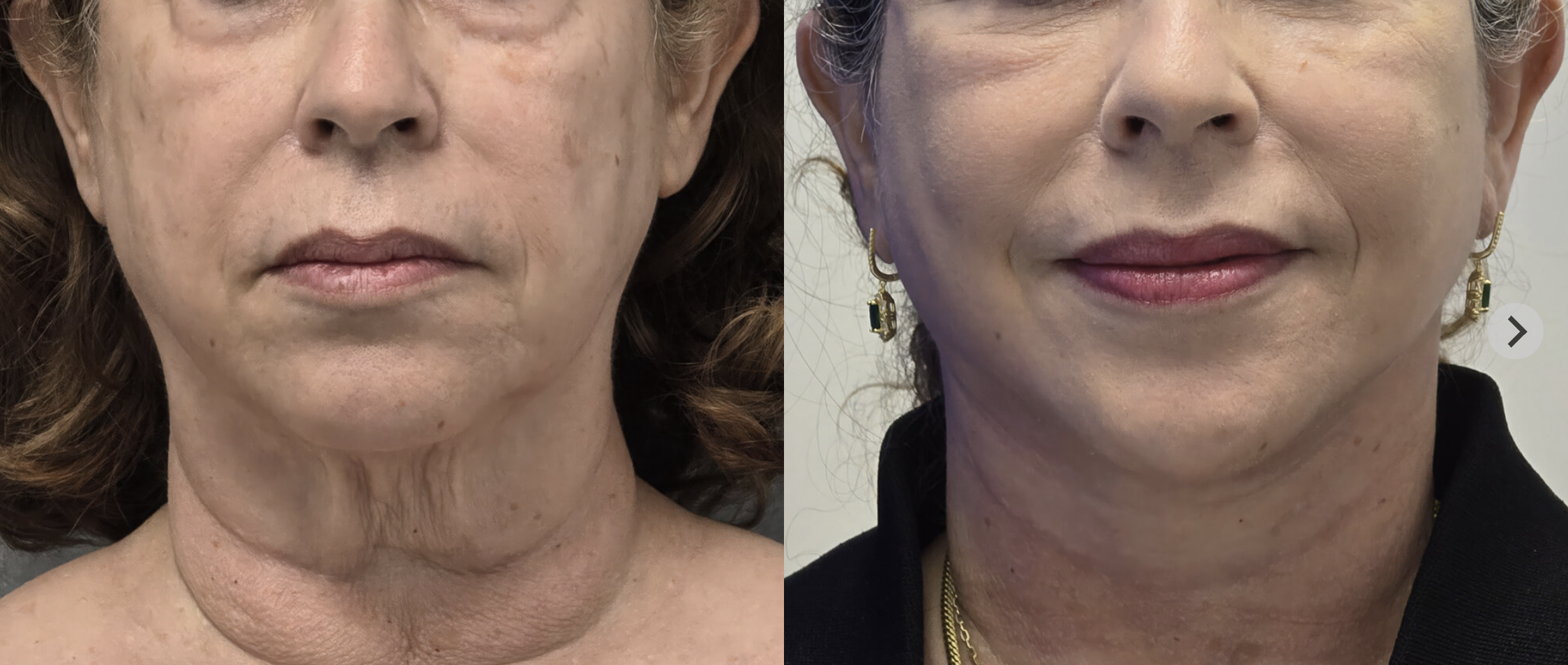 Deep plane facelift before and after, front view