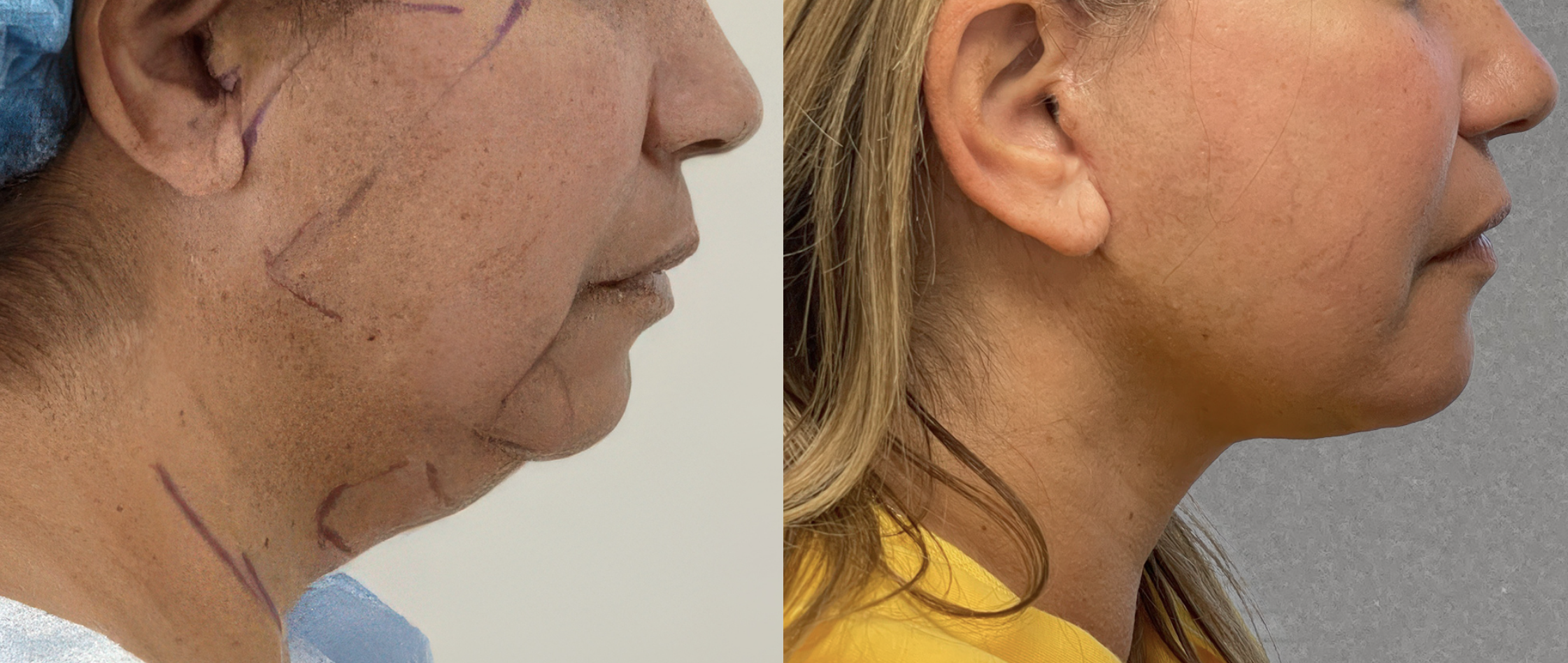 Deep plane facelift before and after, profile view