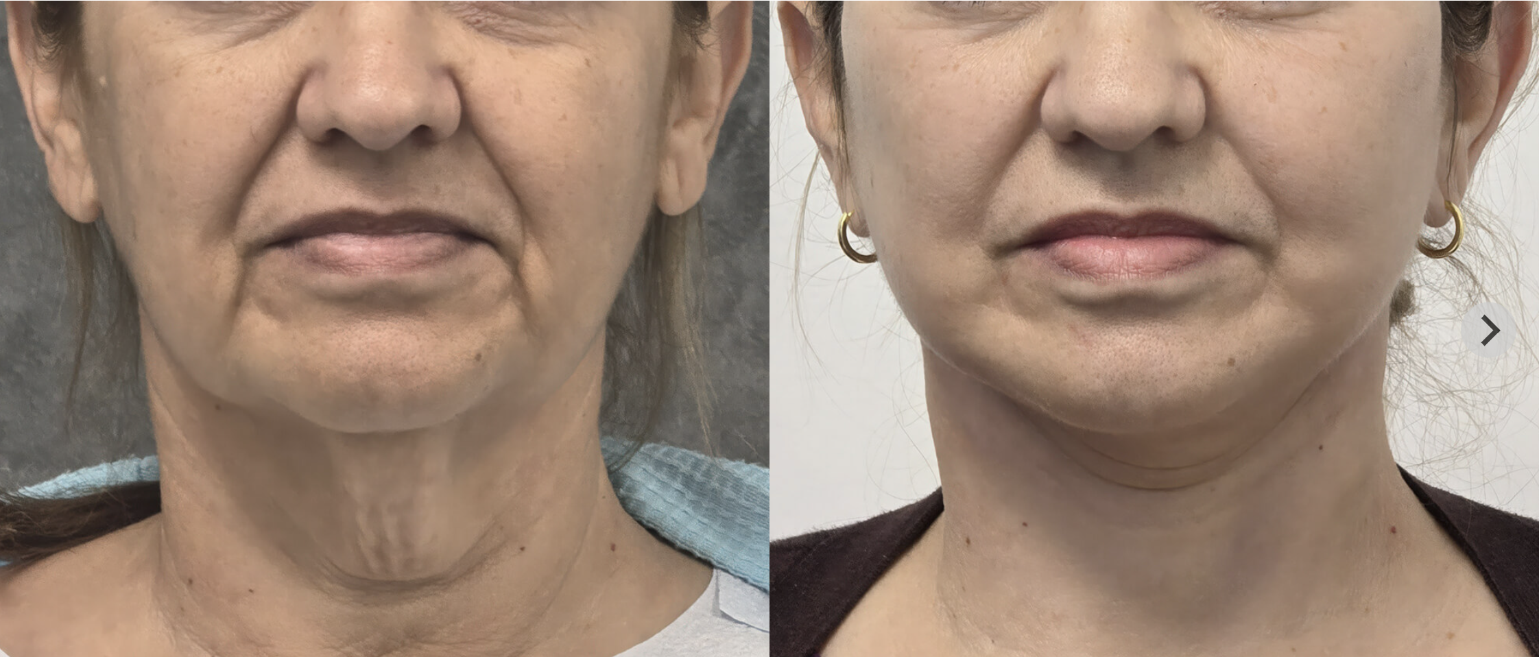 Deep plane facelift before and after, front view