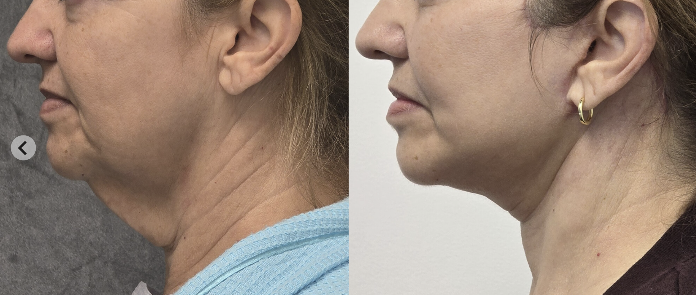Deep plane facelift before and after, profile view